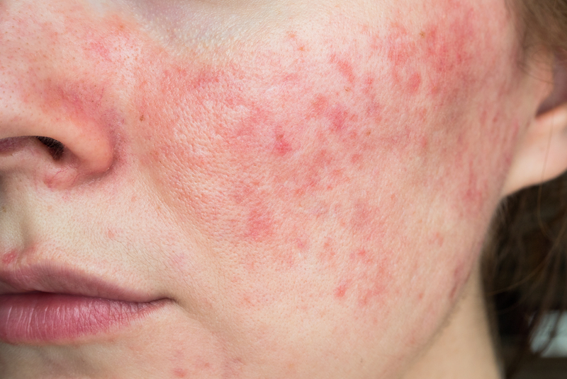 rosacea