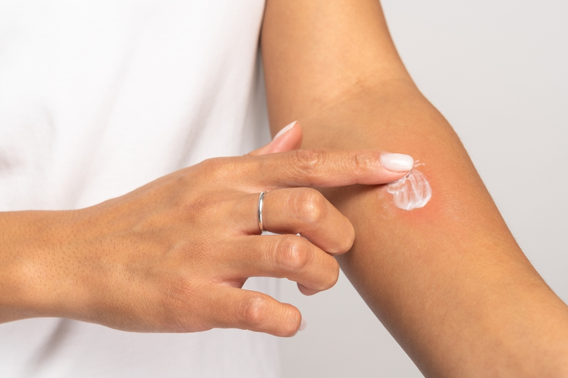 woman putting cream on rash